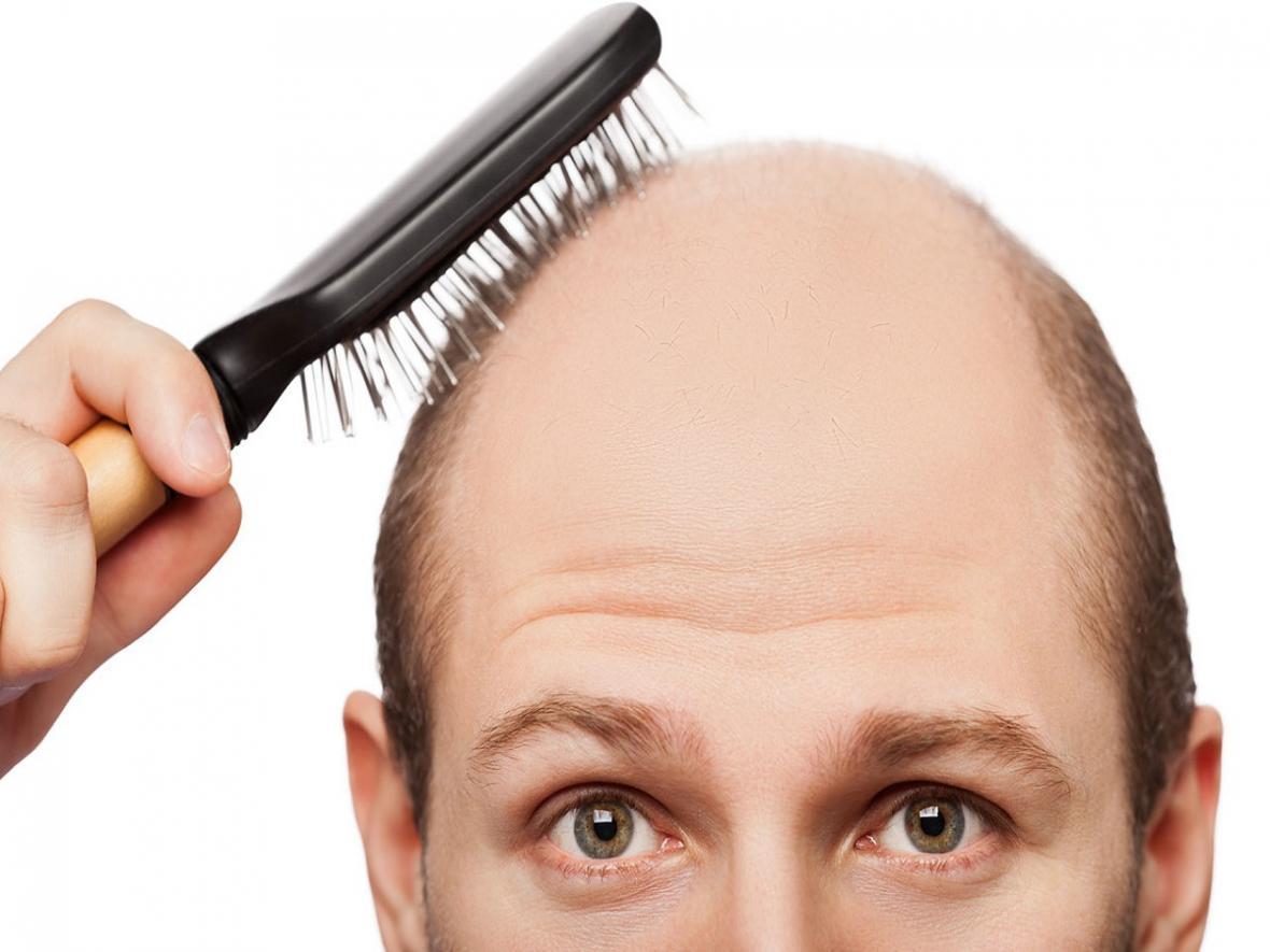 کدام ویتامین برای درمان و جلوگیری از ریزش مو مفید است؟